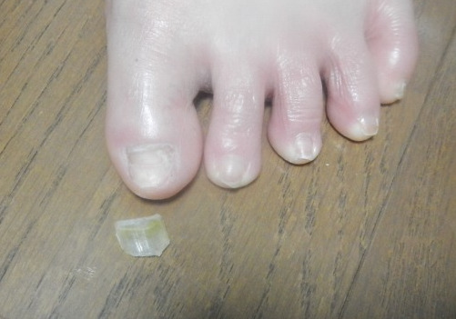 左足の親指の爪